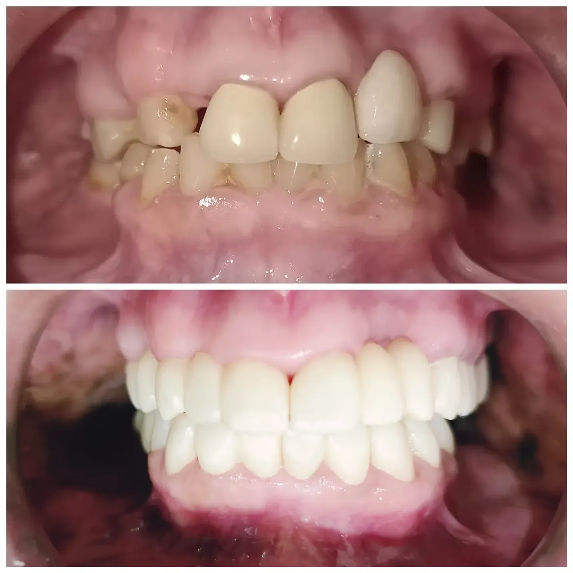 Full Smile Designing case with Zirconia crowns
