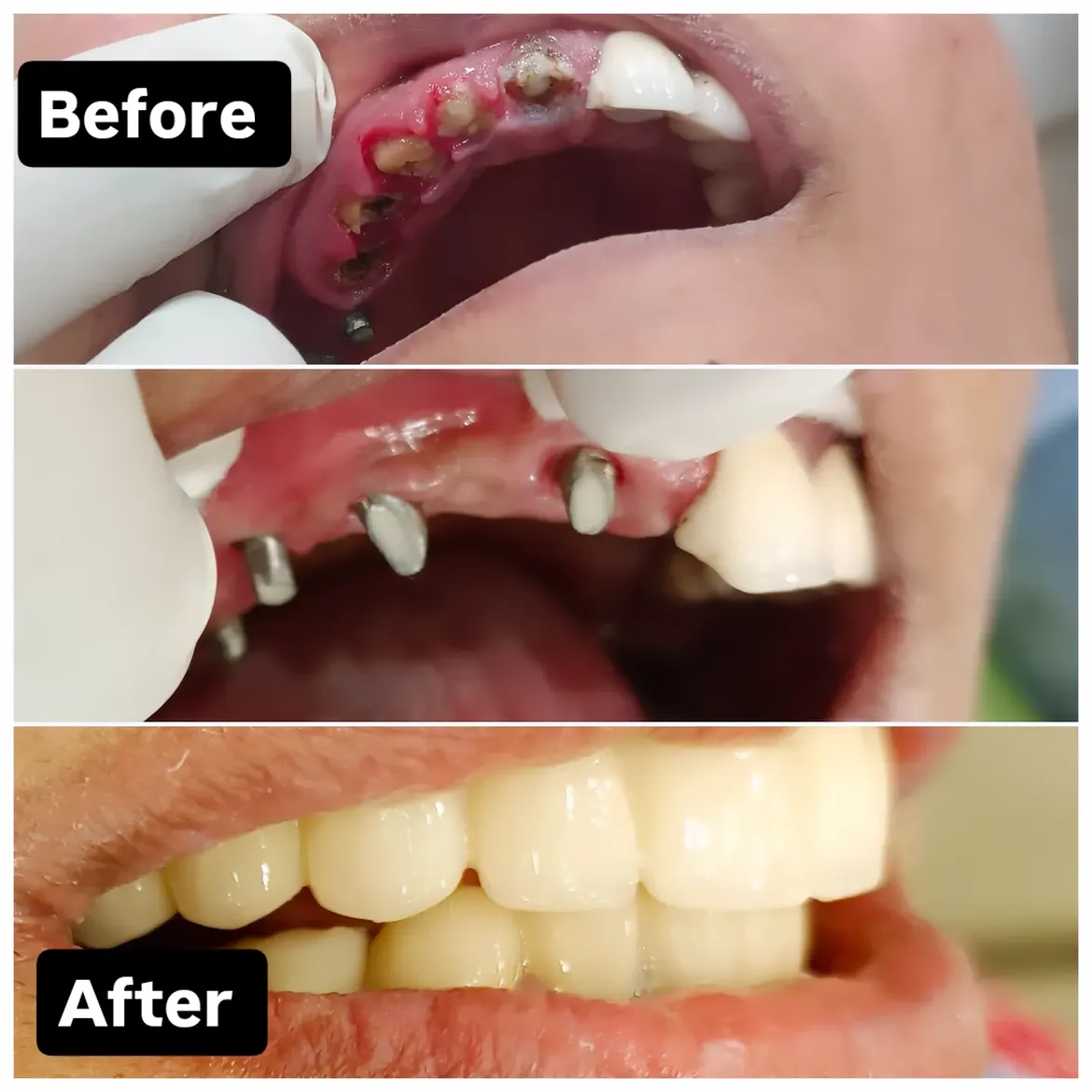 Replacement of root stumps with dental implants and zirconia crowns