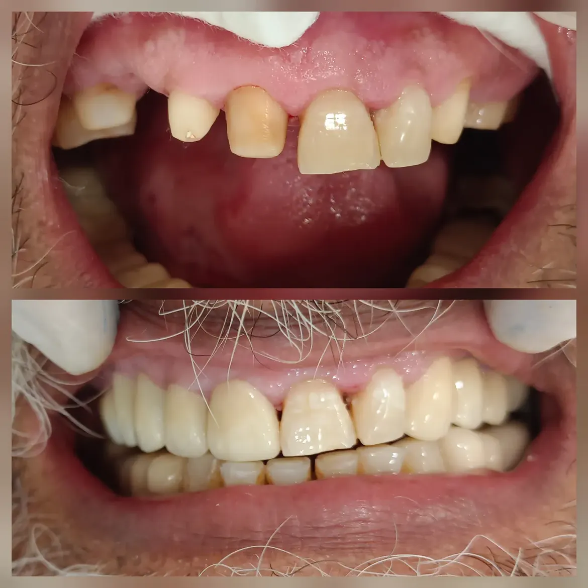 Replacement of upper right and left teeth with zirconia crowns