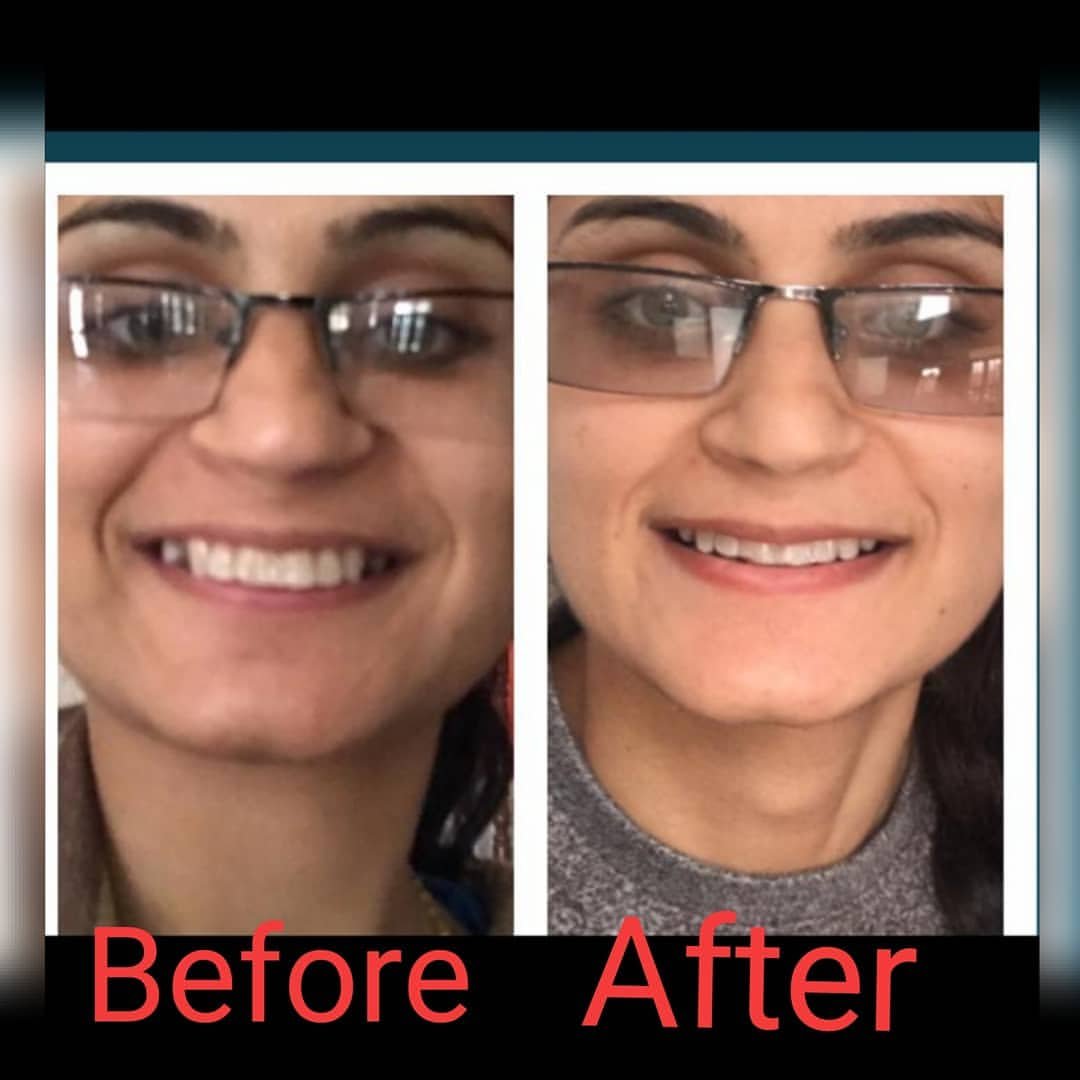 #SMILE TRANSFORMATION WITHOUT BRACES#ALIGNERS