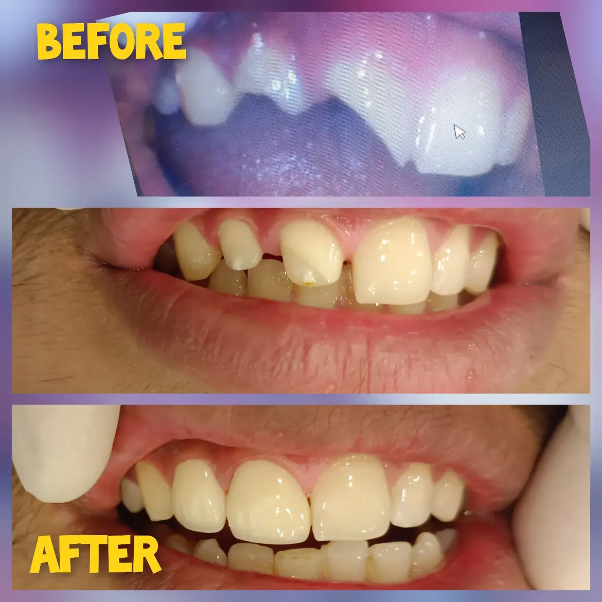 Traumatic case of upper incisors 11,12Did RCT and post and coreInsertion of Zirconia crown
