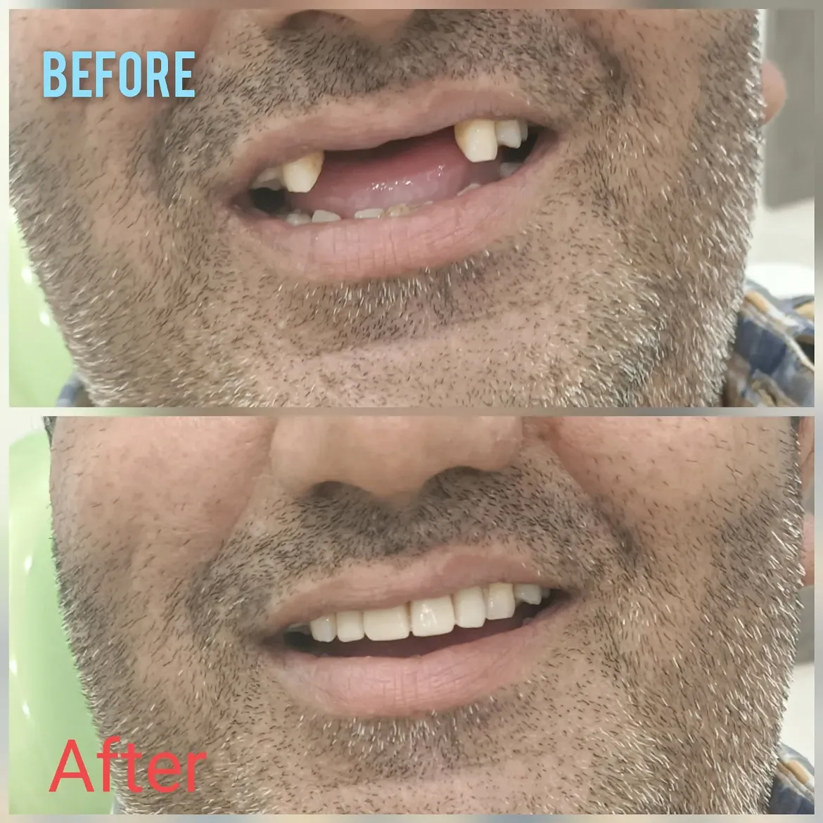 Upper Anterior Missing teeth replaced with RPD