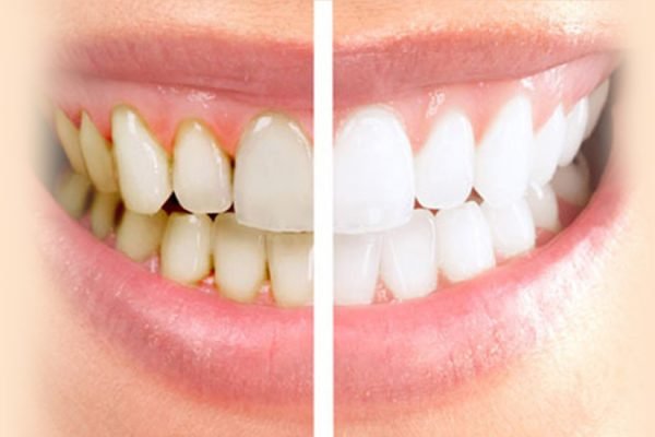teeth-cleaning-polishing